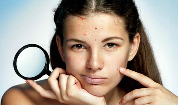 Chocolate Causa Espinillas Mismo? - SaludResponde.Org 1 Chocolate Causa Espinillas Mismo? - SaludResponde.Org 1