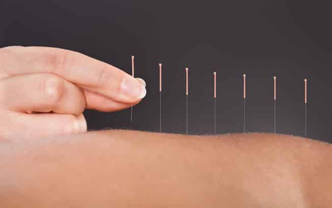10 Beneficios de la Acupuntura para la Buena Forma y Salud 1 10 Beneficios de la Acupuntura para la Buena Forma y Salud 1