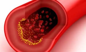 Hipercolesterolemia Familiar – Síntomas, Diagnóstico y Tratamiento