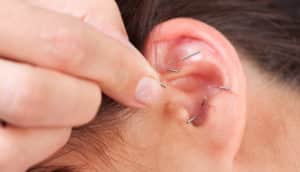 Cómo Funciona la Auriculoterapia Para Adelgazar