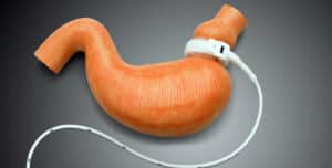 El Síndrome de Dumping -, los Síntomas de la Dieta y del Tratamiento de