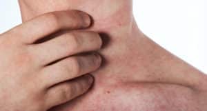 Miliaria en la piel - ¿Qué es, causas y tratamiento