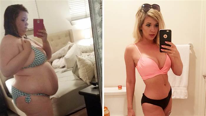 La mujer Es la Cirugía Bariátrica, Pero Sólo se Puede Perder de 68 kg, Con un Cambio de Hábitos 1 La mujer Es la Cirugía Bariátrica, Pero Sólo se Puede Perder de 68 kg, Con un Cambio de Hábitos 1