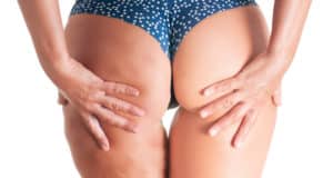 8 Consejos Para Eliminar La Celulitis