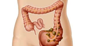 La Diverticulitis Tiene Cura? Tratamiento y Cuidados
