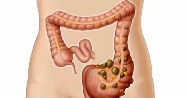 La Diverticulitis Tiene Cura? Tratamiento y Cuidados 1 La Diverticulitis Tiene Cura? Tratamiento y Cuidados 1
