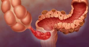 La diverticulitis aguda - ¿Qué es, síntomas, dieta y tratamiento