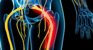 Dolor en el nervio ciático - ¿Qué es, síntomas y tratamiento