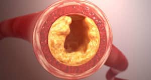 Embolia grasa – Lo que es, riesgos, síntomas, tratamiento, causas y cuidados