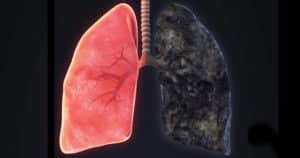 El enfisema pulmonar - ¿Qué es, síntomas, causas y tratamiento
