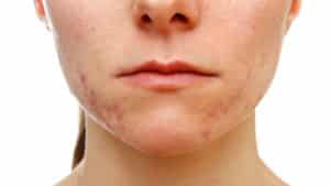 Como Secar Espina Inflamada – Consejos y Cuidados
