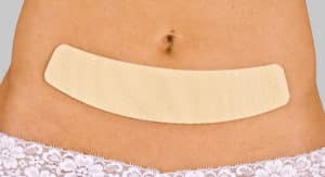 Cinta de Silicona para Cicatriz – Cómo Funciona, Para Qué Sirve y Cómo Utilizar