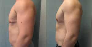 6 Remedios para Ginecomastia Más Usados