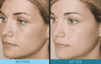 El ácido glicólico para qué sirve y cómo utilizar el antes y el después, y por los consejos 1