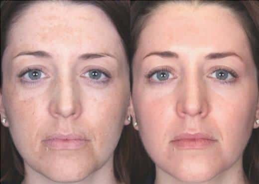 El ácido glicólico para qué sirve y cómo utilizar el antes y el después, y por los consejos 3