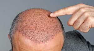 Implante de Cabello Funciona? Riesgos, Cuánto Cuesta, Antes y Después y Consejos