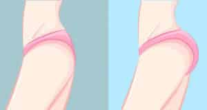 Todo acerca de los implantes de silicona en los glúteos (Gluteoplastia)