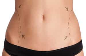 ¿Cuánto Es El Precio De Una Liposucción? – SaludResponde.Org