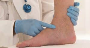 La mala circulación en las piernas, como tratamiento, medicina natural, síntomas y consejos