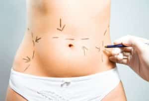 Como es una Cirugía de Abdominoplastia?