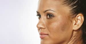 ¿Cuál es, en el Mejor de Ácido para el Melasma?