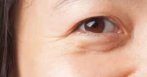 Cómo Evitar las Ojeras y Bolsas Naturalmente? Y Cómo Tratar?