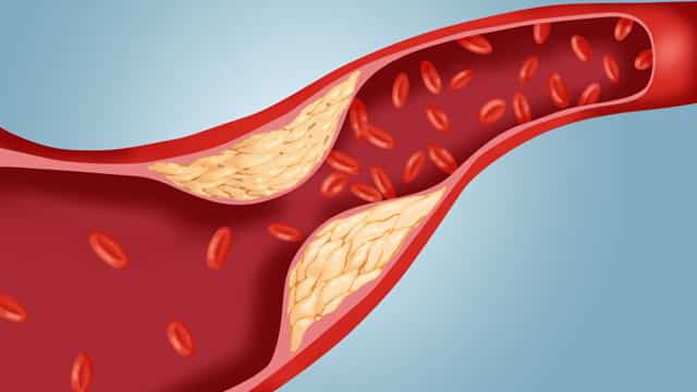 Hipercolesterolemia - Causas, Dieta, Ejercicio, Tratamiento y Síntomas 1 Hipercolesterolemia - Causas, Dieta, Ejercicio, Tratamiento y Síntomas 1