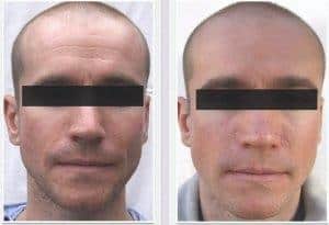 El peeling de cristal, que es el antes y el después, Para que sirve y por los consejos 1