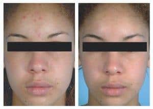 El peeling de cristal, que es el antes y el después, Para que sirve y por los consejos 2