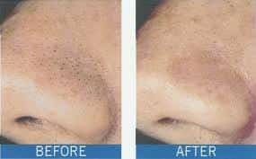 El peeling de cristal, que es el antes y el después, Para que sirve y por los consejos 3