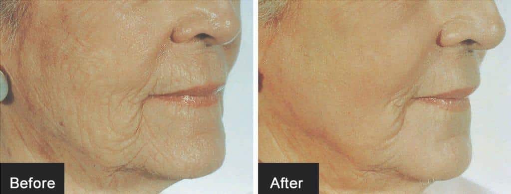 El peeling de cristal, que es el antes y el después, Para que sirve y por los consejos 4