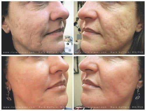 El peeling de cristal, que es el antes y el después, Para que sirve y por los consejos 5