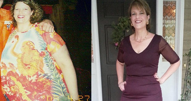 Una mujer de 51 Años de edad, la Denegación de la Cirugía Bariátrica y Adelgazar 40 kilos por Cuenta Propia 1 Una mujer de 51 Años de edad, la Denegación de la Cirugía Bariátrica y Adelgazar 40 kilos por Cuenta Propia 1