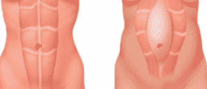 Diástase Abdominal – El Que es, Tratamiento, Ejercicios y Cirugía