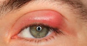 Cómo tratar el terçol en el ojo? Es contagioso? Causas, síntomas y qué hacer?
