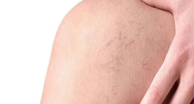 Consejos de Ejercicios Para el Tratamiento de Varices 1 Consejos de Ejercicios Para el Tratamiento de Varices 1
