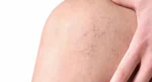12 Síntomas de las Varices – Como Tratar y Consejos