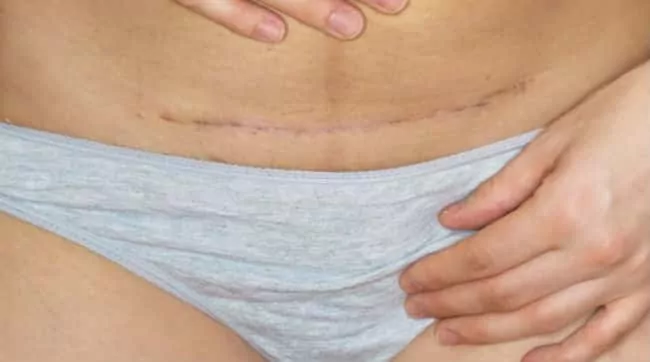Cicatriz de cesárea - Cuidado para cicatrizar y cómo aclarar