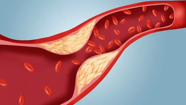 Hipercolesterolemia – Causas, Dieta, Ejercicio, Tratamiento y Síntomas